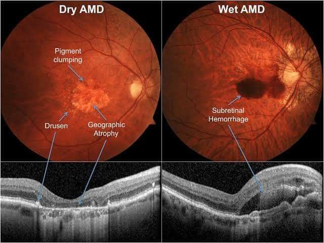 Source: MYEYESPECIALIST