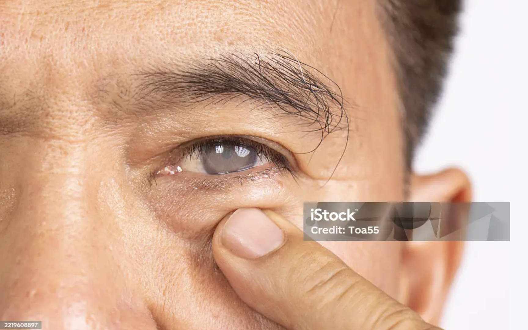 Glaucoma — clinical photo