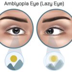 Source: Eye-deology Vision Care