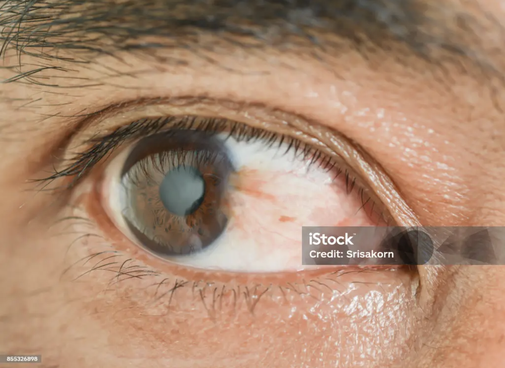 Cornea & Pterygium — clinical photo