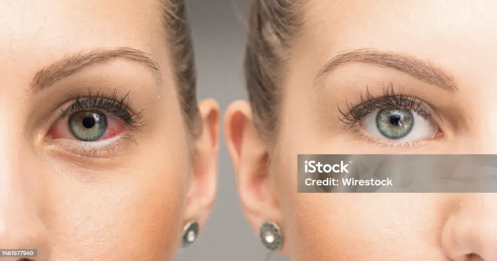 Dry Eyes & Conjunctivitis — clinical photo