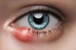 Source: stoney creek eyecare