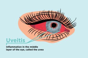 Source: CreakyJoints