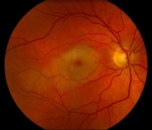 Source: EyeRounds Ophthalmology and Visual Sciences