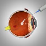 Wet AMD: Anti-VEGF injections to reduce abnormal blood vessel growth, laser therapy, and photodynamic therapy
