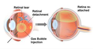 Source: The Retina Partners
