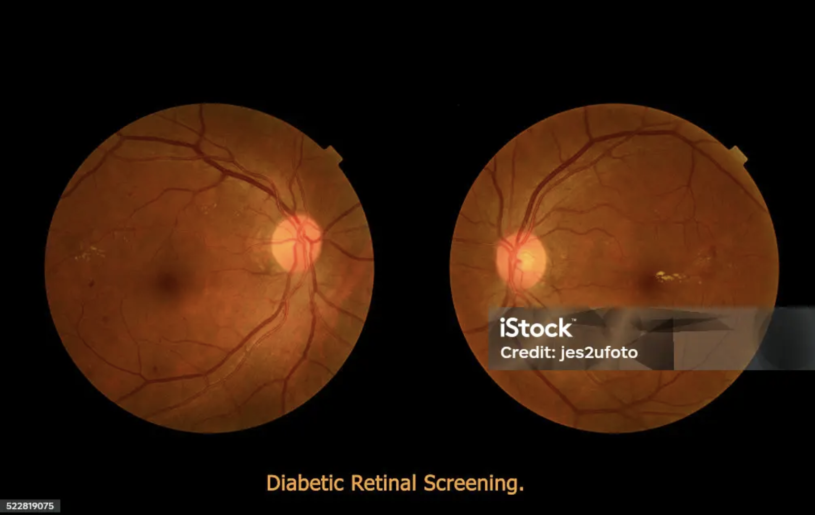 Diabetic Eye Care — clinical photo