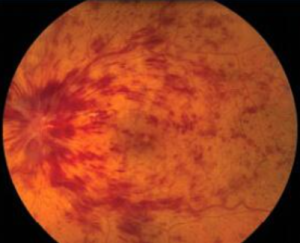Source: retina associates of Kentucky