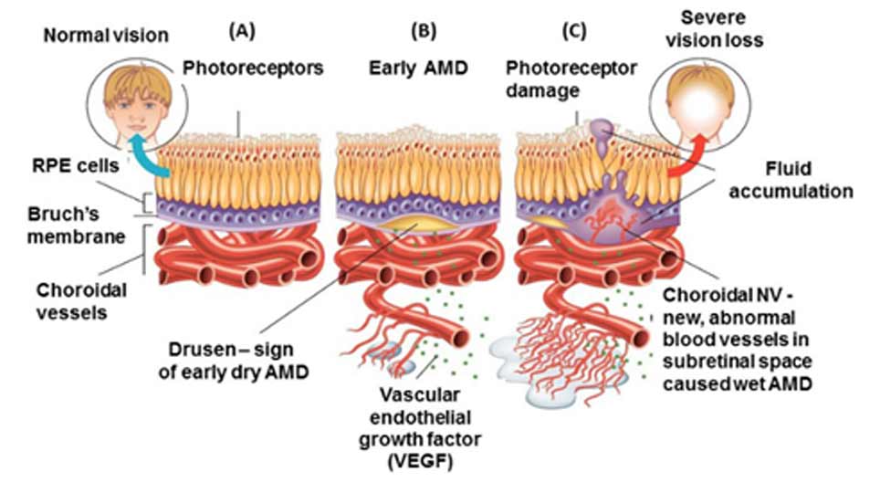 Figure 1: Illustration of age-related macular degeneration. (Image from www.dreamstime.com)