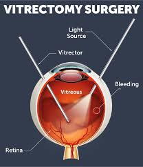Source: Wolfe Eye Clinic