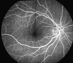 Source: Retina Consultants of Hawaii