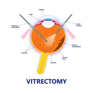 Source: Elman Retina Group