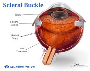 Source: All About Vision