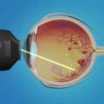 Source: American Academy of Opthalmology