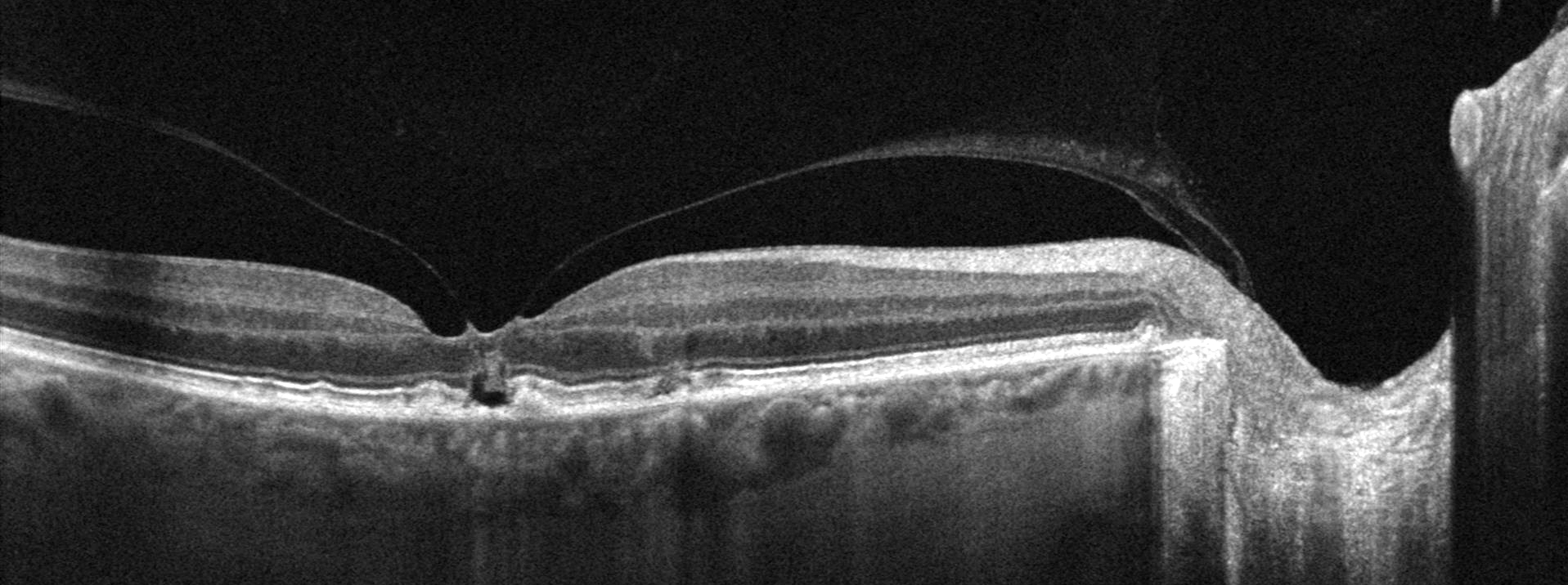 Optical Coherence Tomography (OCT): Provides detailed images of the retina.