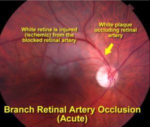 Source: Retina Vitreous Associates of Florida