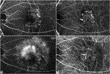Polypoidal choroidal vasculopathy — source: City Eye Centre