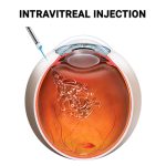 Source: Vitreous Retina Macula Consultants of New York