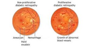 Source: Sydney ophthalmic specialist