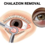 Source: vitreous retina macula