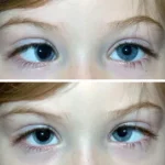 Source: American Academy of Ophthalmologist