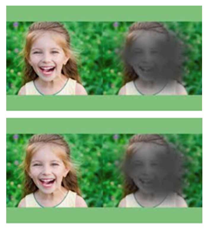 Figure 2: ARMD will affect the central vision. Without treatment, the dark area centrally will enlarge. (Image from allaboutvision.com)