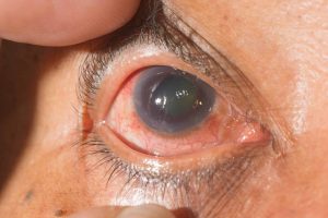 Source: EyeSight Hawaii