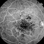 Fluorescein Angiography: Highlights abnormal blood vessels in wet AMD.