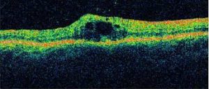 Source: Saratoga Opthalmology