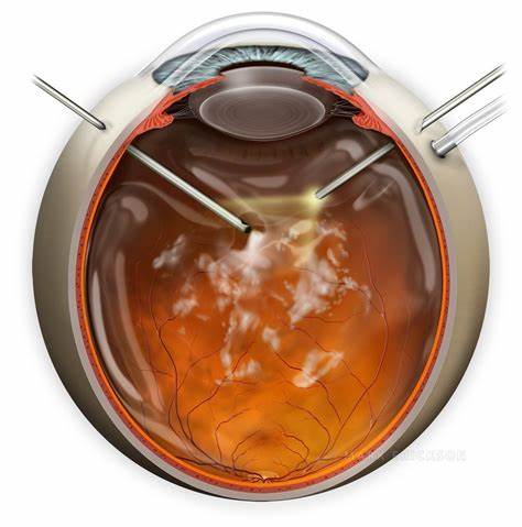 Understanding Vitrectomy Surgery : a Guide for Patients