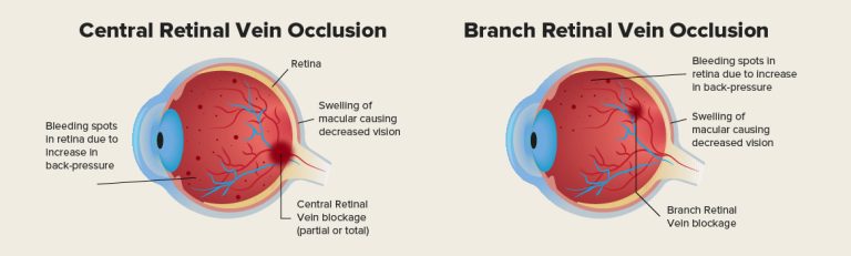 Source: Shinagawa eye centre